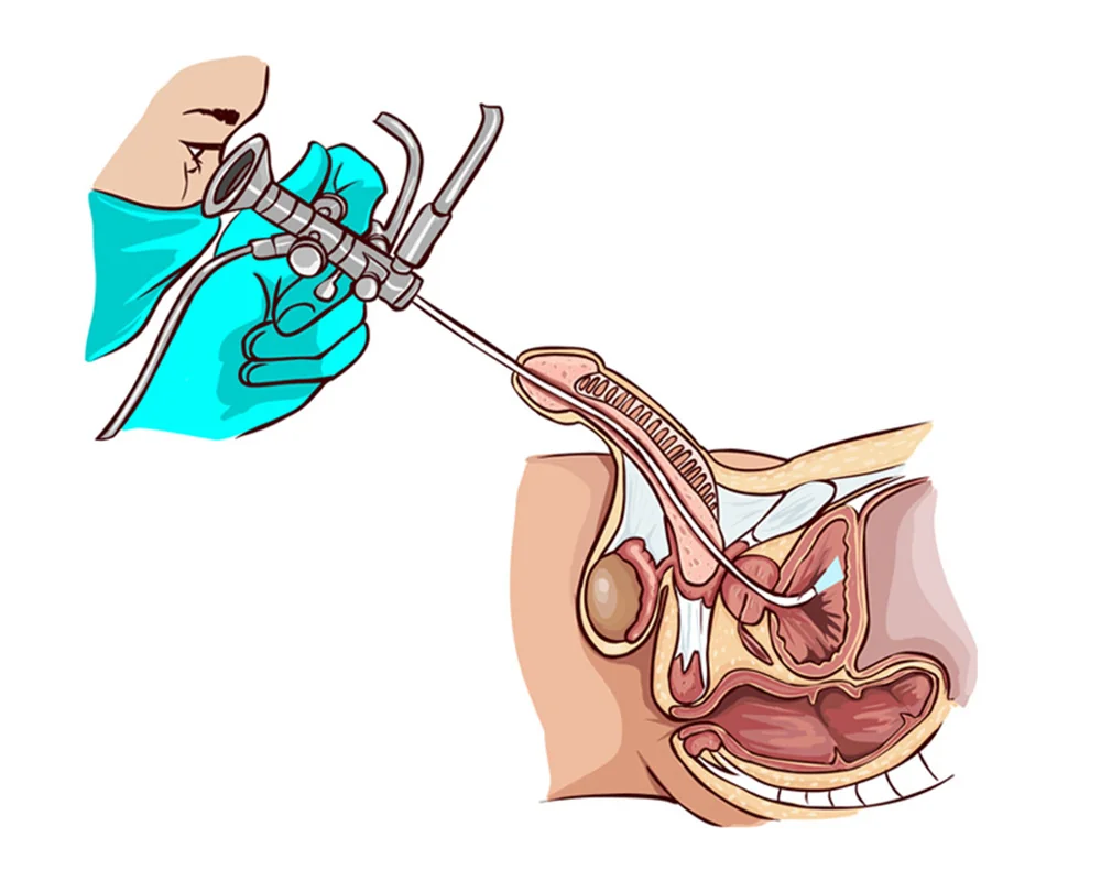 Cirurgias Endoscópicas para Cálculos Urinários: Tudo o que Você Precisa Saber