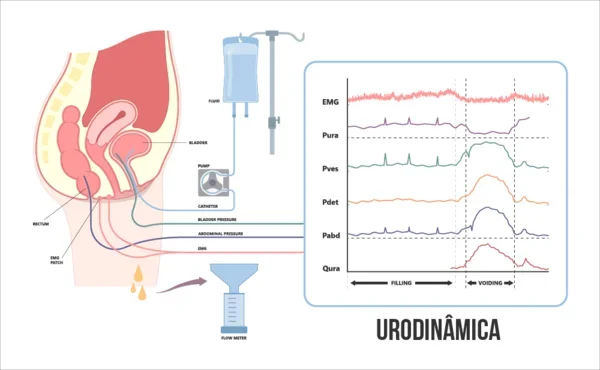 Estudo Urodinâmico com Eletromiografia: avaliação completa da função da bexiga e do assoalho pélvico